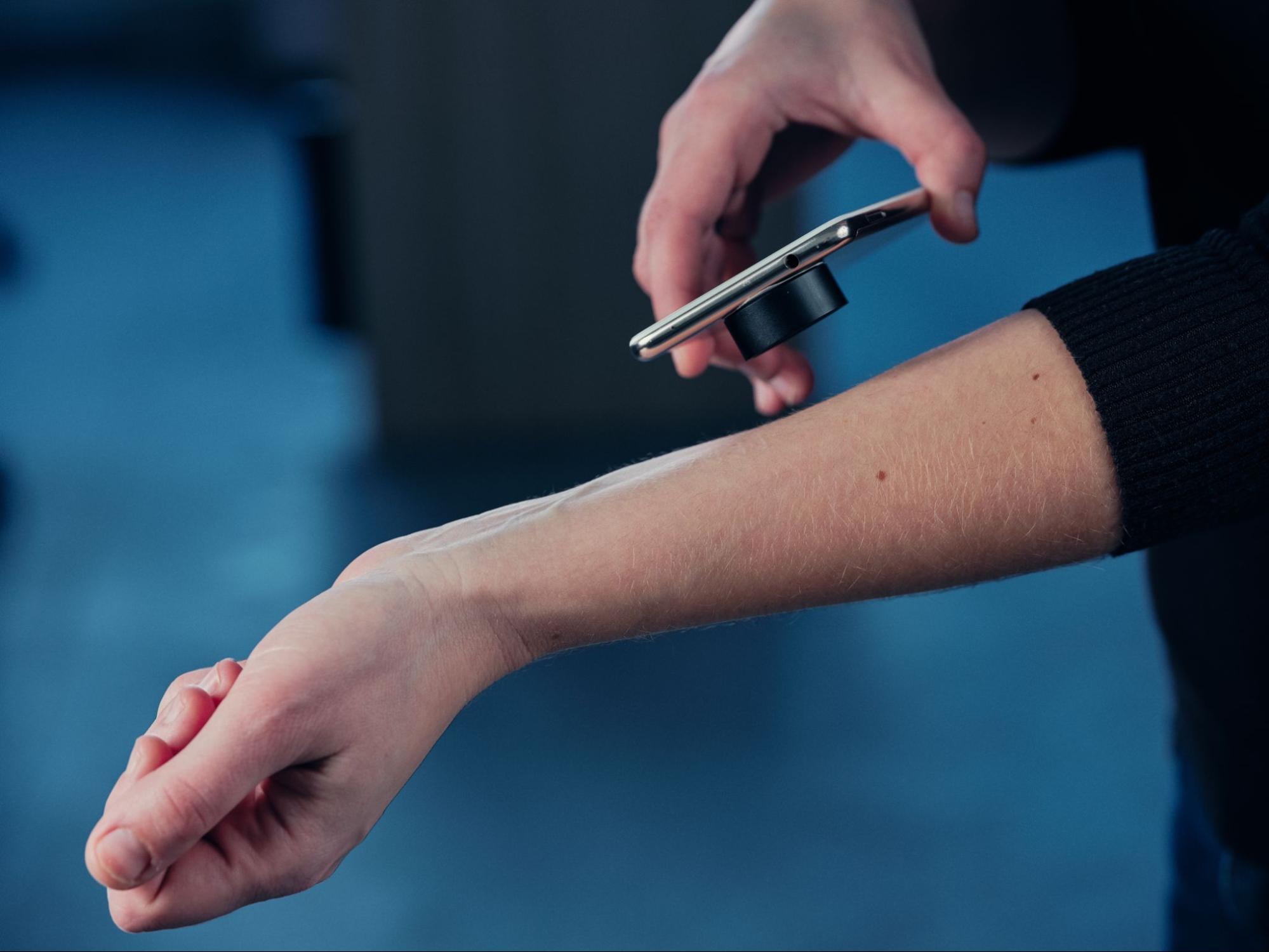 A man is using his iPhone and the SkinView application for skin cancer diagnostics.